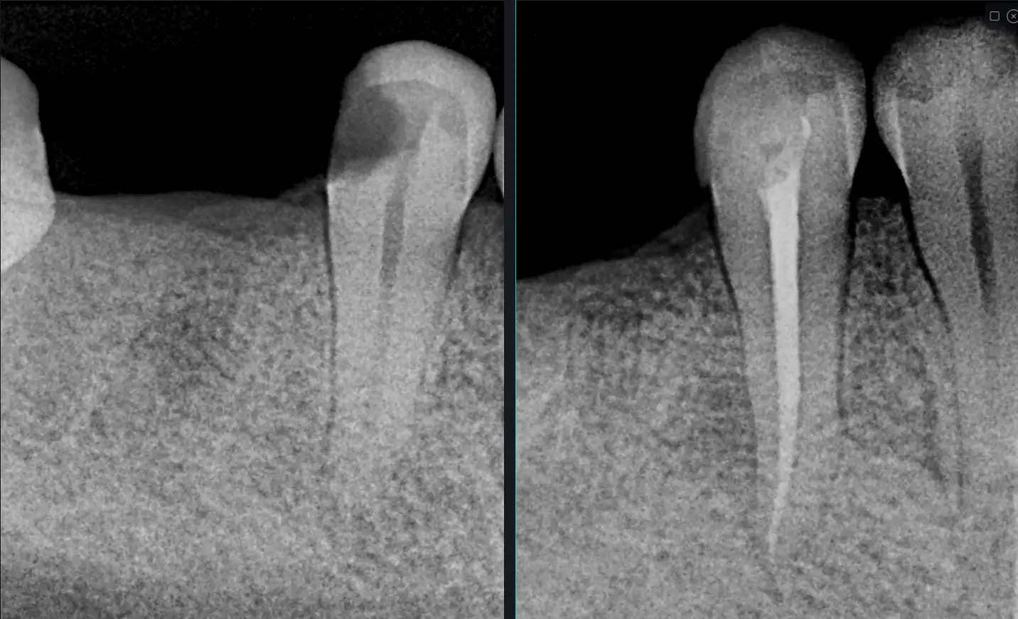 Tratamiento de endodoncia para conservar diente afectado