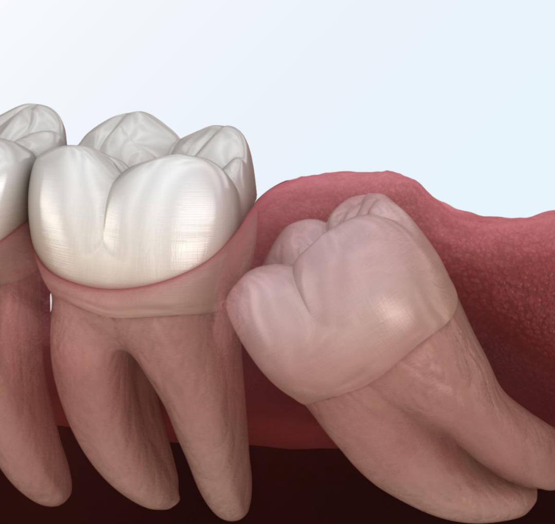 Procedimiento de cirugía oral para extracción dental