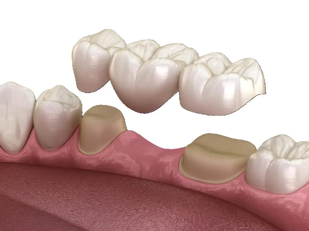 Prótesis fija para recuperar función y estética