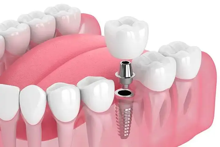 Implante dental utilizado para reemplazar un diente perdido