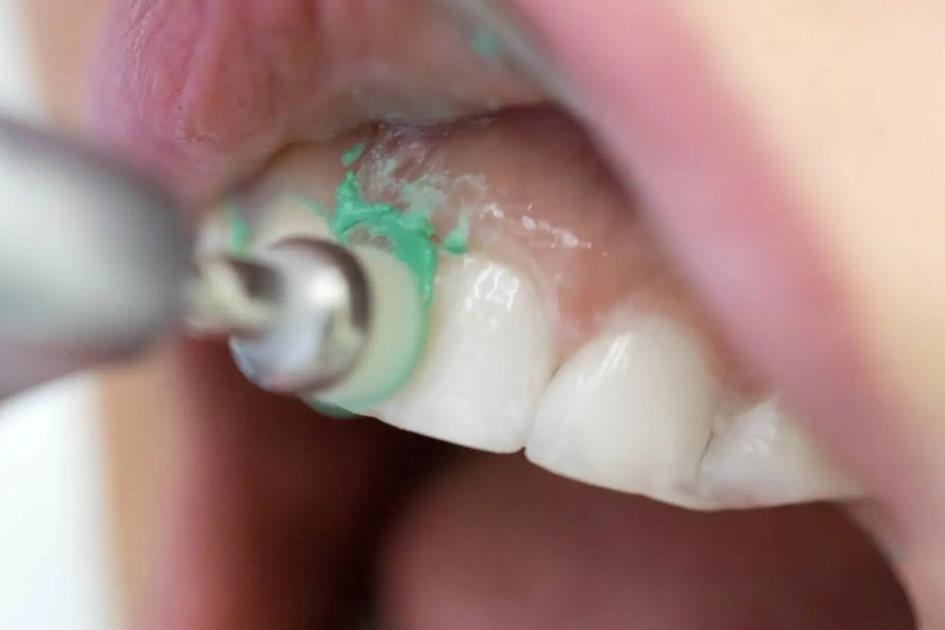 Limpieza dental profesional para cuidar dientes y encías