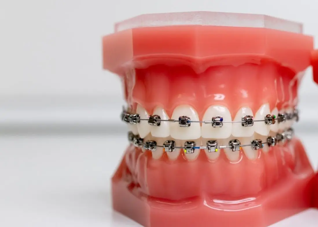 Brackets dentales durante tratamiento de ortodoncia